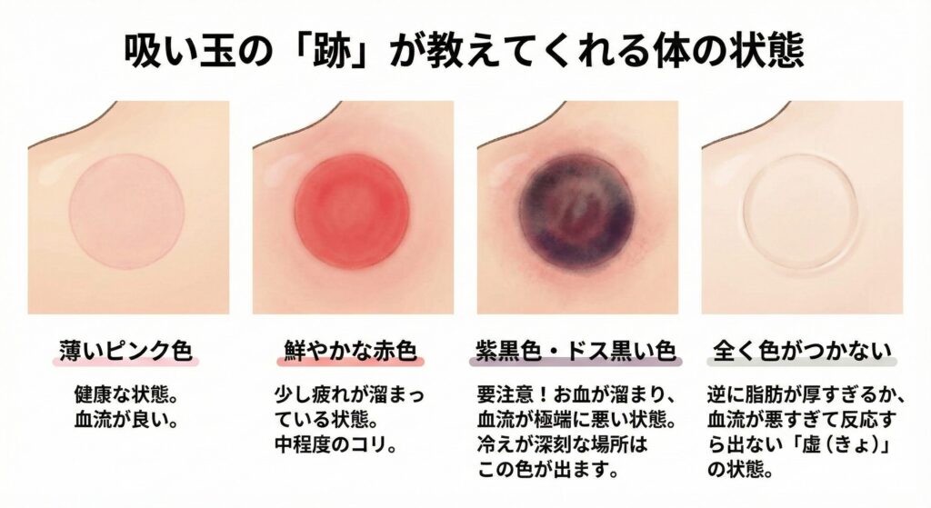 女性に多い「冬の冷え性」対策完全ガイド|整体と吸い玉で基礎体温を上げる方法 11 吸い玉(カッピング)の跡の色が教えてくれる体の状態を解説した図解イラスト。施術後の反応として、「薄いピンク色(健康な状態)」「鮮やかな赤色(中程度のコリ)」「紫黒色・ドス黒い色(お血・重度の冷え)」「全く色がつかない(虚の状態)」の4つのパターンとその原因が示されている比較表。