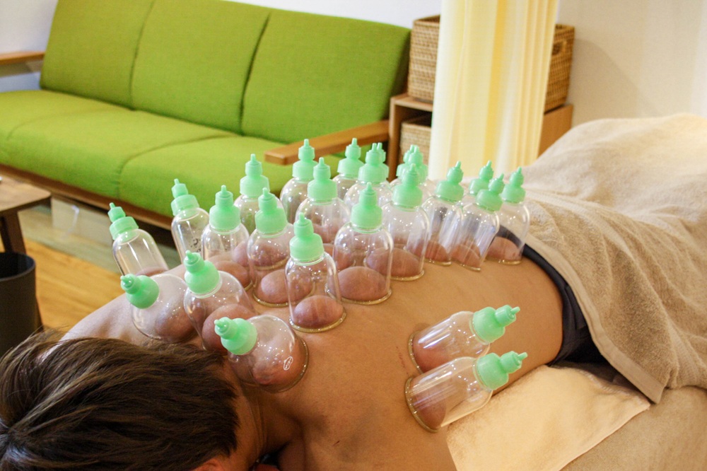 吸玉・カッピング